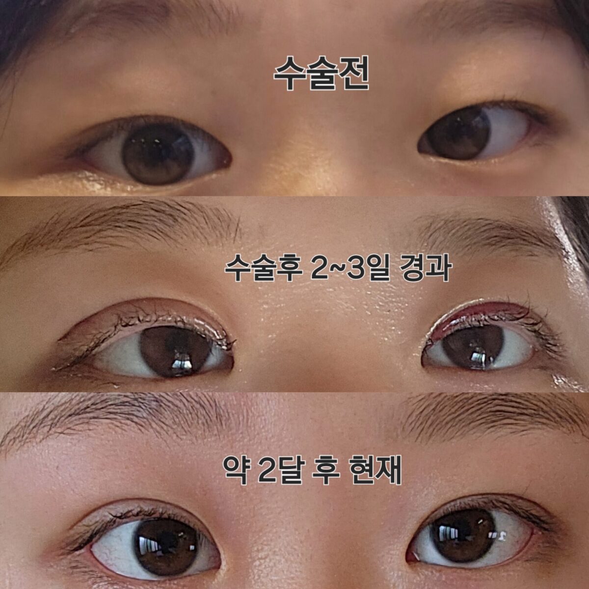 김홍진원장님 자연유착 윗트임 후기