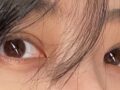 도언록 원장님 매몰+지방이식 후기