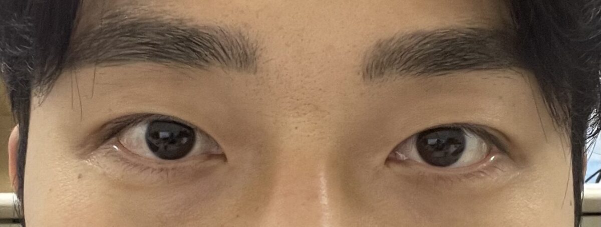 도언록 원장님 자연유착+비절개 눈매교정