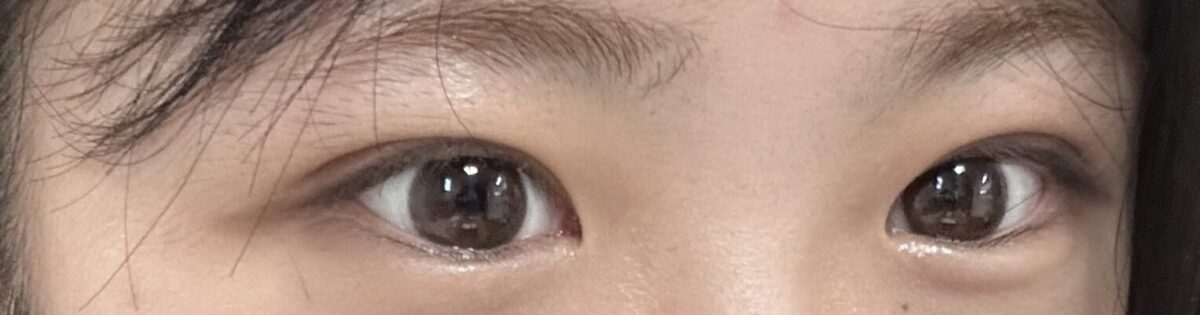 도원록 원장님 + 쌍커풀 매몰(재수술)