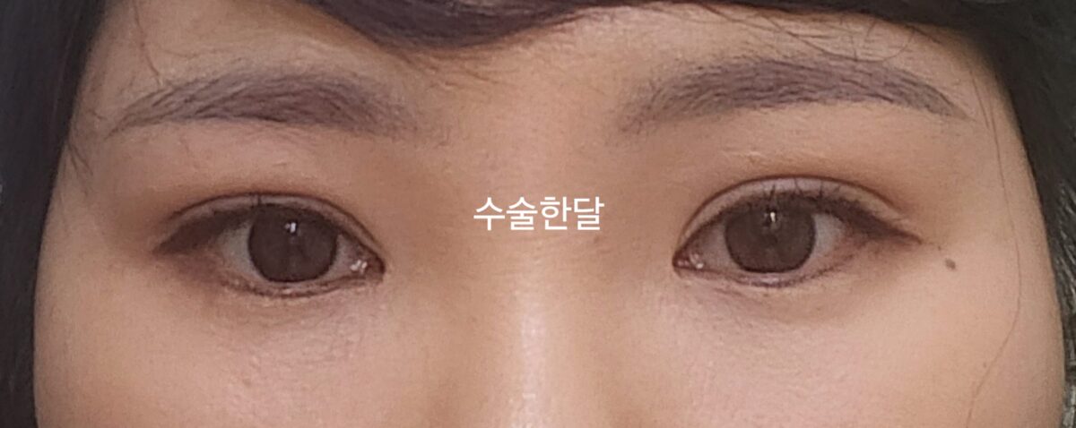 도언록원장님/절개쌍커풀 재수술