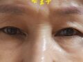 눈성형 후기