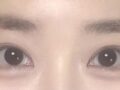 도언록 원장님 쌍수 후기