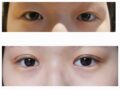 수술후기 (김홍진원장님)