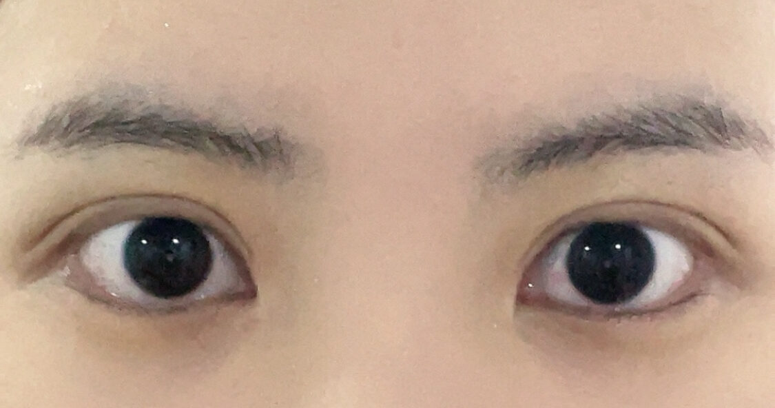 도언록 원장님 쌍수+윗트임 한달 반 후기