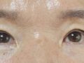 김홍진 원장님 상안검 자연유착후기입니다