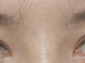 도언록원장님 눈 재수술 후기