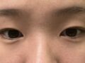 쌍수 2개월차 후기