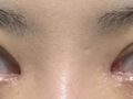 앞트임 재수술 후기