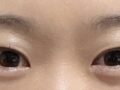 나영수 원장님 수술 후기