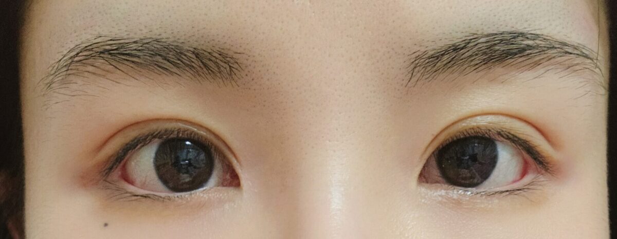 나영수 원장님께 절개 쌍수 재수술+트임 받았어요!!