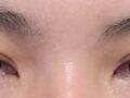 도언록 원장님 자연유착 2달 후기