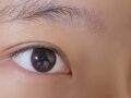일미리 김홍진 원장님 비절개 쌍커풀 후기