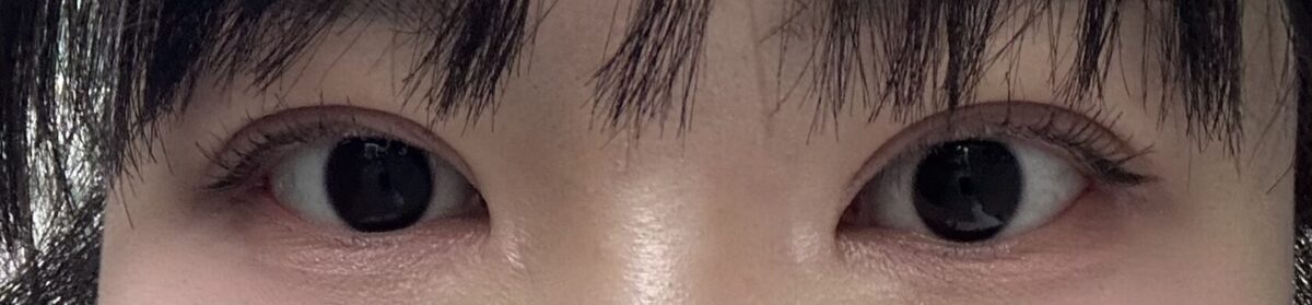 김홍진 원장님 눈 재수술 1달차