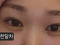 나영수 원장님께 받은 자연유착 수술후기 입니다.