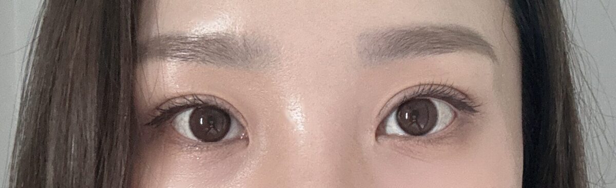 도언록 원장님 눈재수술