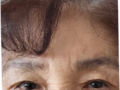 75세 비절개 쌍꺼풀 후기