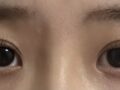 도언록 원장님 눈 첫수술 후기