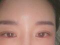 자연유착,얼굴지방이식