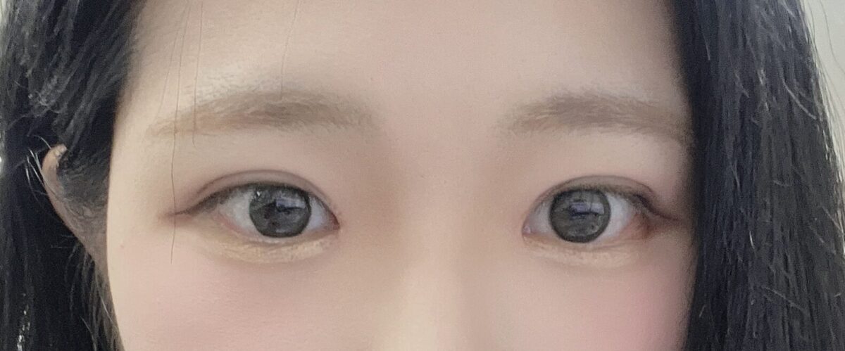 쌍커풀 재수술(절개)앞윗트임(재수술)눈매교정 후기