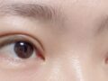 쌍꺼풀(매몰) 수술 후기