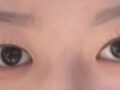 김홍진 원장님 쌍꺼풀 절개