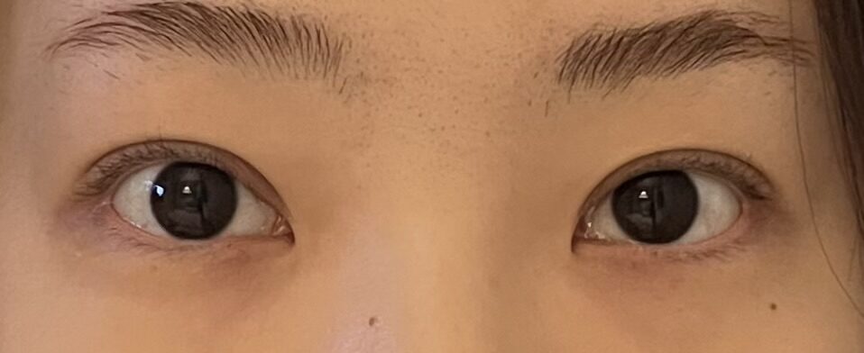 김홍진원장님 자연유착 매몰 윗트임 후기