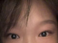 나영수 원장님 쌍꺼풀(절개), 윗트임 후기