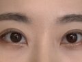 김홍진원장님 쌍꺼풀 후기
