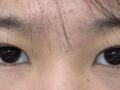 쌍꺼풀 수술 후기 (김홍진 원장님)