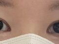 김홍진 원장님께 재수술 (매몰 후기)