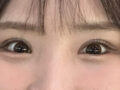 눈재수술 후기