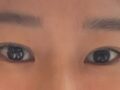 일미리 쌍커풀 절개 재수술 후기