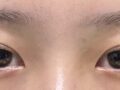 김홍진 원장님 쌍수 68일차 후기입니다.