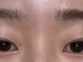 도언록원장님께 받은 자연유착 + 앞트임