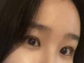김홍진 선생님 쌍커풀 수술 후기