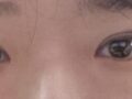 김홍진원장님께 앞트임+매몰쌍커풀 시술후 3개월차입니다