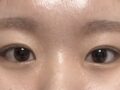 일미리 자연유착 쌍수