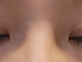 1mm  쌍수 3개월차