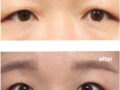 김홍진 원장님 눈썹거상술