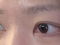 일미리 도언록 원장님 자연유착+윗트임 3.5개월차 후기