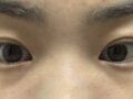 일미리 김홍진원장님 눈밑지방재배치 후기