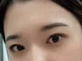 일미리 도언록 원장님 쌍커플 재수술+윗트임 후기