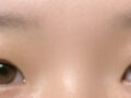 일미리성형외과 김홍진 원장님 절개 후기
