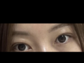 일미리/절개 눈매교정 김홍진원장님