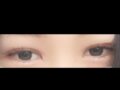 1mm 김홍진원장님 매몰