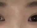 도언록 원장님 쌍수후기