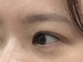 일미리 도언록 원장님의 자연유착 쌍카수술후기입니다