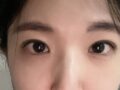 김홍진원장님께 자연유착 수술했어요