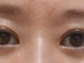 자연유착 재수술, 눈밑지방재배치